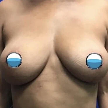 Front-view after photo of breast explant and lift surgery performed by Dr. David Rankin in Jupiter, FL, case 4195.