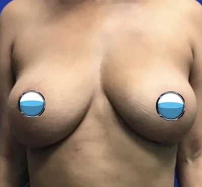 After - Case #4195: Breast Explant and Anchor Lift