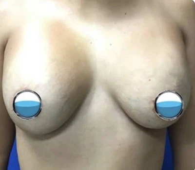 Before - Case #4203: Breast Explant and Lollipop Lift