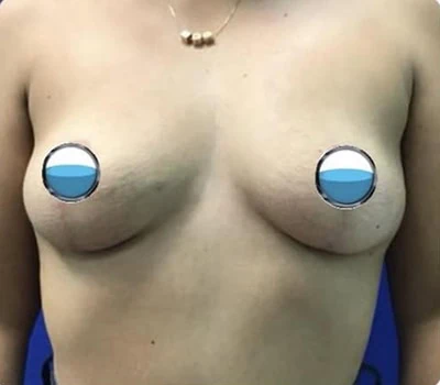 After - Case #4203: Breast Explant and Lollipop Lift