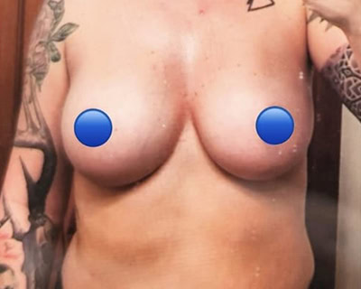 Before - Case #4213: Breast Explant