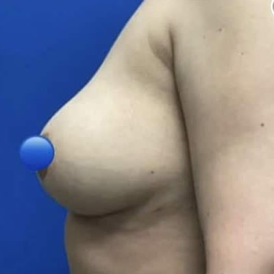 After - Case #4050: Breast Explant and Wise Pattern Lift