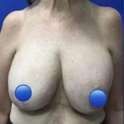 Before - Case #4069: Breast Explant and Anchor Lift