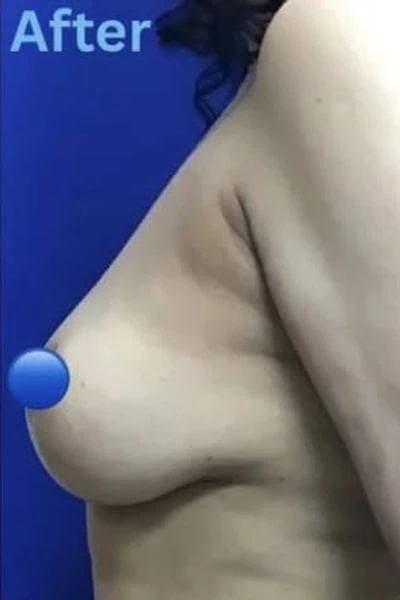 After - Case #4082: Breast Explant and Lift