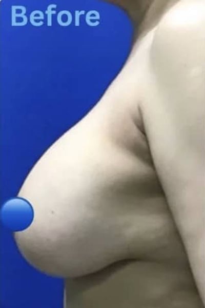 Before - Case #4082: Breast Explant and Lift