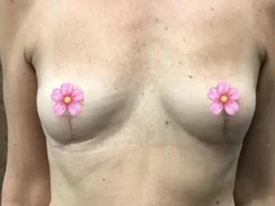 After - Case #4111: Breast Explant Surgery and Lift