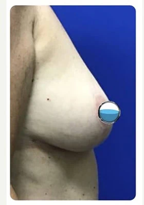 After thumbnail