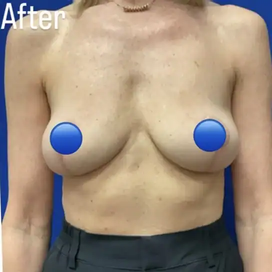 Front-view after photo of breast explant surgery performed by Dr. David Rankin in Jupiter, FL case 4118.
