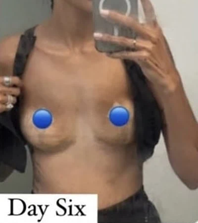 After - Case #4073: Breast Explant Surgery