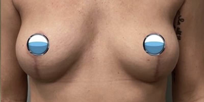 After - Case #4123: Breast Explant with Lift