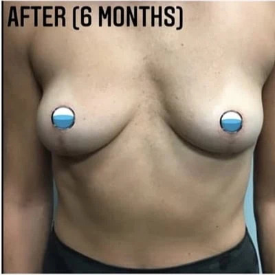 After - Case #4130: Breast Explant and Lift