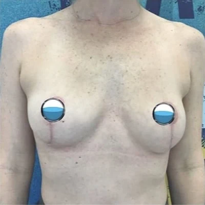 After - Case #4133: Breast Explant and Lift