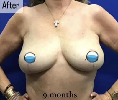 After - Case #4227: Breast Explant and Anchor Lift