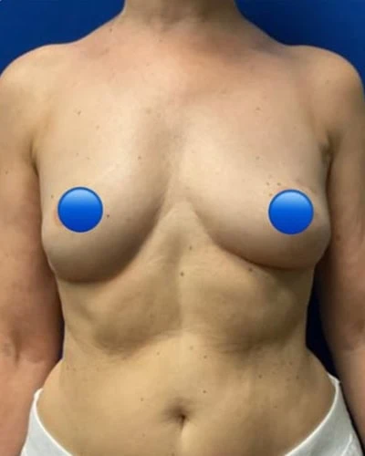 After - Case #4265: Breast Explant