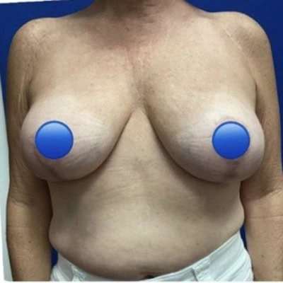 After - Case #4382: Breast Explant and Anchor Lift