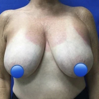 Before - Case #4382: Breast Explant and Anchor Lift