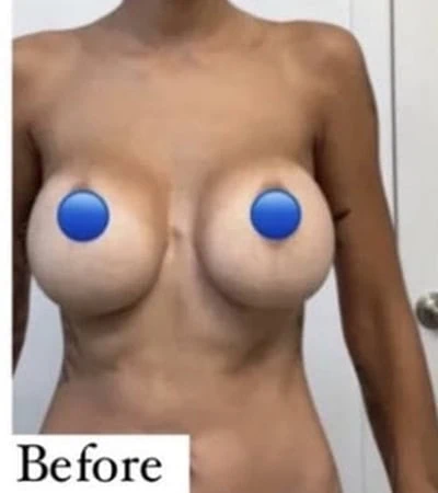 Before - Case #4073: Breast Explant Surgery