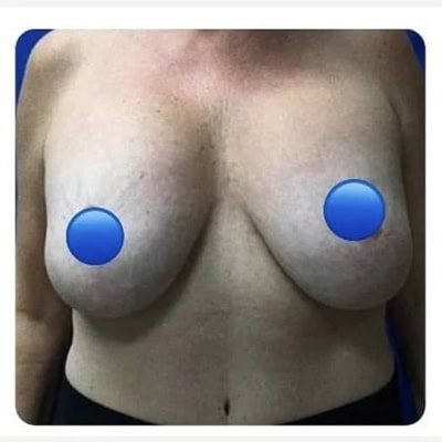 Before - Case #4099: Breast Explant and Anchor Lift