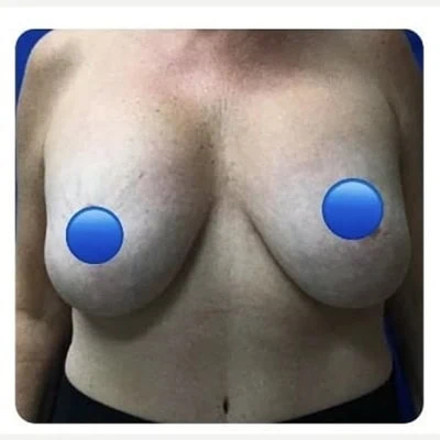 Before - Case #4099: Breast Explant and Anchor Lift