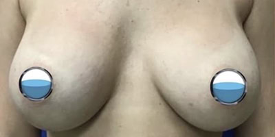 Before - Case #4123: Breast Explant with Lift