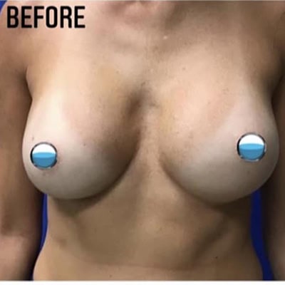 Before - Case #4130: Breast Explant and Lift