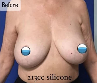 Before - Case #4227: Breast Explant and Anchor Lift