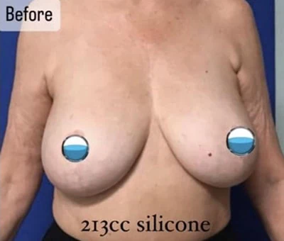 Before - Case #4227: Breast Explant and Anchor Lift