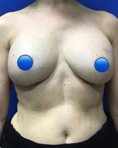 Before - Case #4265: Breast Explant