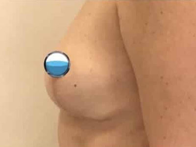 After - Case #4117: Breast Explant with Lift