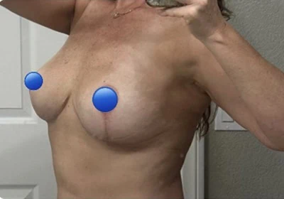 After - Case #4398: Breast Explant, Total Capsulectomy and Lift