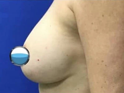 Before - Case #4117: Breast Explant with Lift