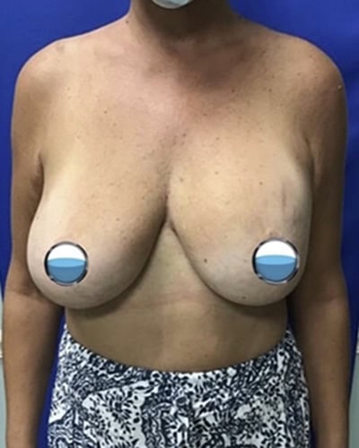 Before - Case #4120: Breast Explant and Lift