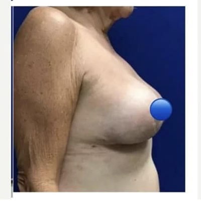 After - Case #4079: Breast Explant and Anchor Lift