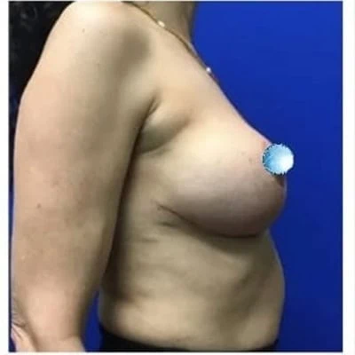After - Case #4100: Breast Explant and Anchor Lift