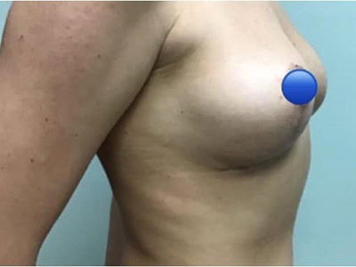 After - Case #4114: Breast Explant and Lift