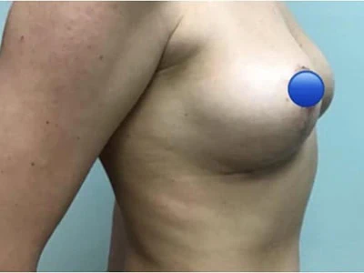 After - Case #4114: Breast Explant and Lift