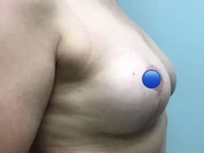 After - Case #4127: Breast Explant and Lift