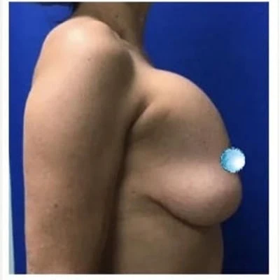 Before - Case #4100: Breast Explant and Anchor Lift