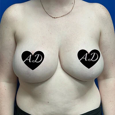 Front-view after photo of breast reduction surgery performed by Dr. Allyson Deziel in Jupiter, FL, case 3521.