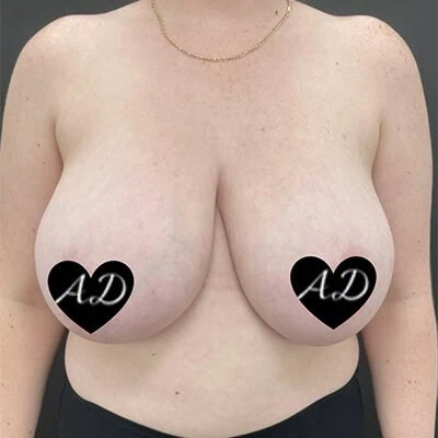 Front-view before photo of breast reduction surgery performed by Dr. Allyson Deziel in Jupiter, FL, case 3521.