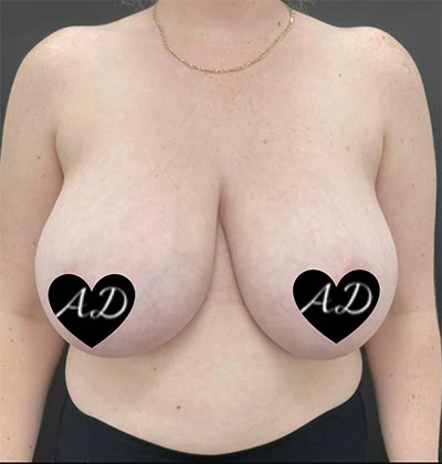 Before thumbnail