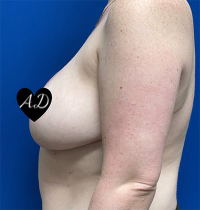 After - Case #3521: Breast Reduction