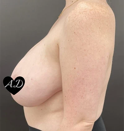 Before - Case #3521: Breast Reduction