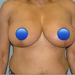 Front-view after photo of breast reduction surgery performed by Dr. David Rankin in Jupiter, FL, case 4234.