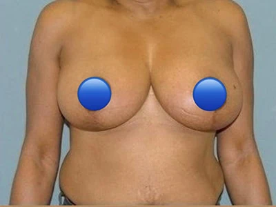 After - Case #4234: Breast Reduction Surgery