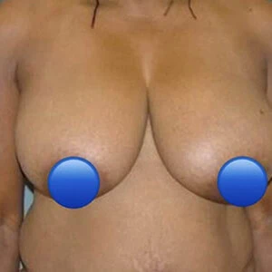 Front-view before photo of breast reduction surgery performed by Dr. David Rankin in Jupiter, FL, case 4234.