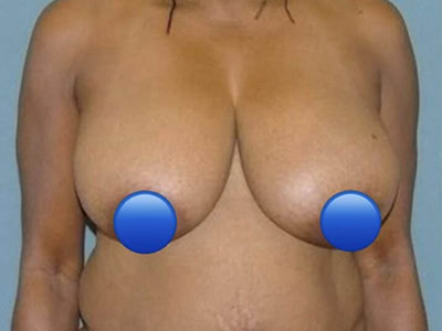 Before - Case #4234: Breast Reduction Surgery