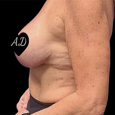 After - Case #3502: Breast Reduction Surgery