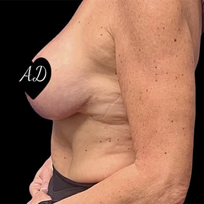 After - Case #3502: Breast Reduction Surgery