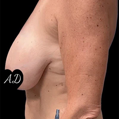 Before - Case #3502: Breast Reduction Surgery